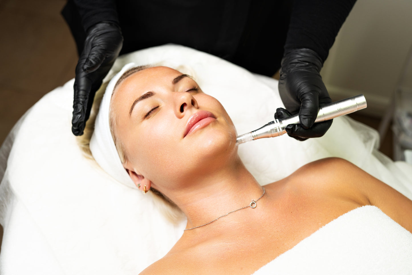 Microneedling